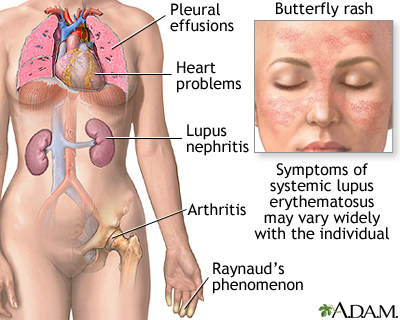  lupus ban đỏ, lupus erythematosus, lupus ban đỏ dạng đĩa, discoid lupus erythematosus, lupus ban đỏ hệ thống, systemic lupus erythematosus